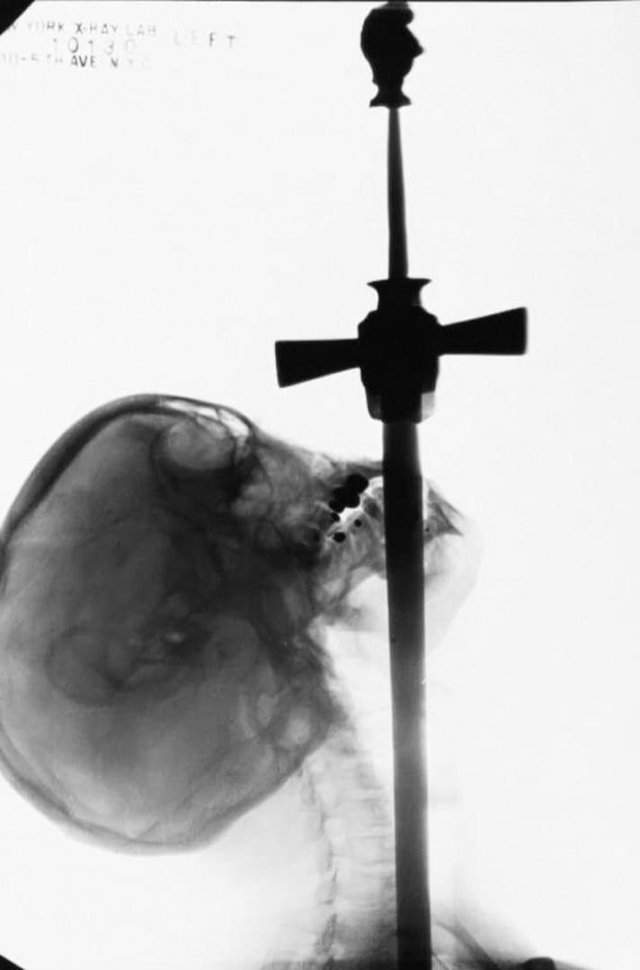 Рентгеновский снимок шпагоглотателя. Одна из самых уникальных фотографий того времени, 1928 год.