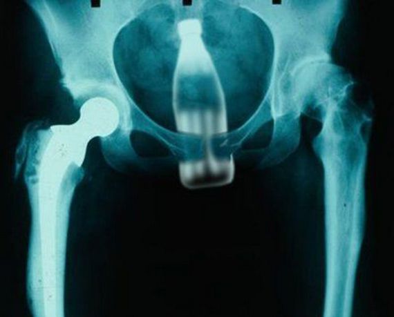 Уникальная коллекция рентгеновских снимков. Лишние вещи в организме