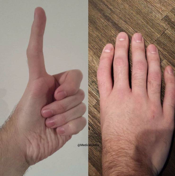 Длинный большой палец