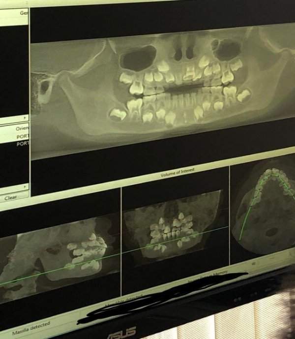Рентген зубов ребенка