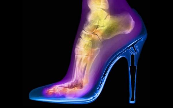 Рентген женской ступни в туфлях на каблуке