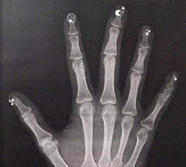 Рентген с маникюром