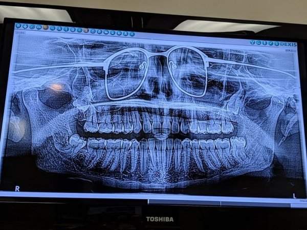 Делали панорамный рентгеновский снимок челюсти и забыли снять очки