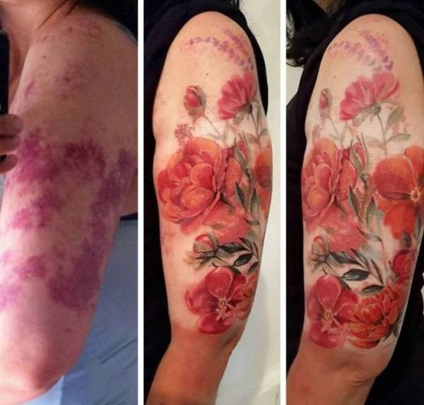 До и после перекрытия родимого пятна татуировкой