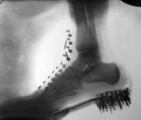 Рентген ноги Николы Теслы, который он сделал сам