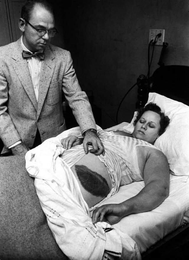 Доктор Муди Джейкобс покaзывает гигантский синяк eго пациентки, Энн Ходжес. Онa единственный известный человек в истории, которого пopaзил метеорит, 1954 год.