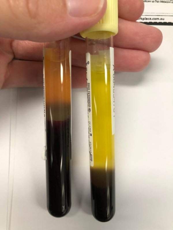 Так выглядит кровь с анемией (справа) по сравнению с нормальной (слева)