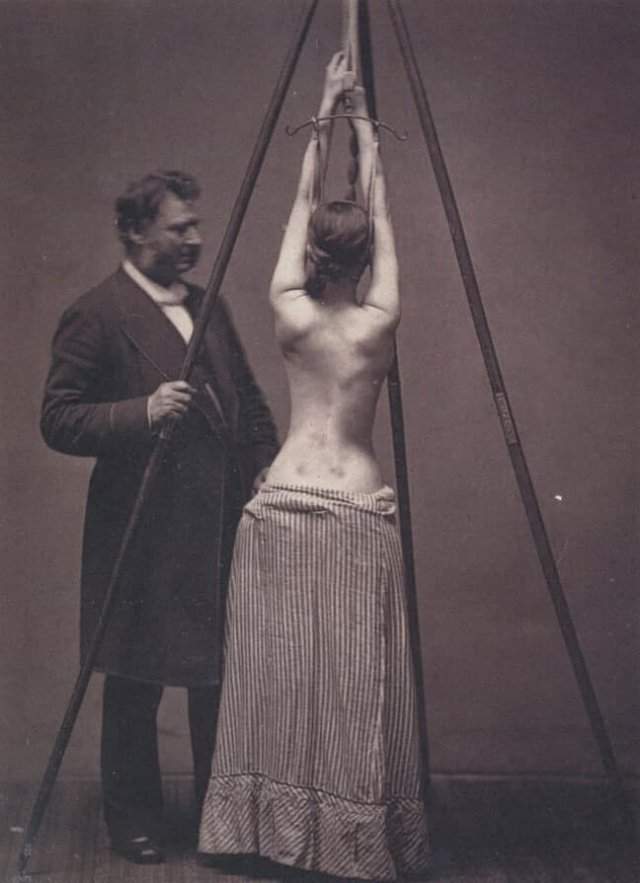 Доктор Льюис Сейр лечит сколиоз, Англия, конец XIX века.