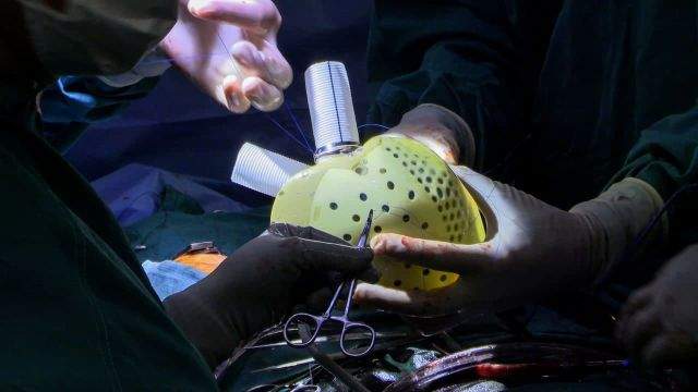 хирурги имплантируют искусственное сердце