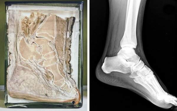 Нога слона и рентген ноги человека
