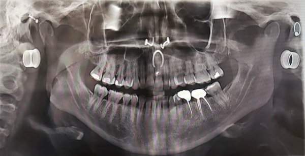 Рентген моих зубом примерно 2 месяца назад