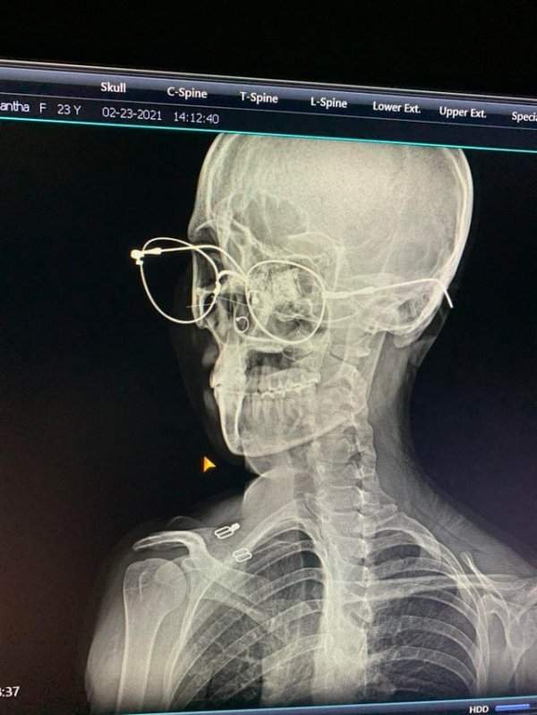 Парень надел очки во время рентгена