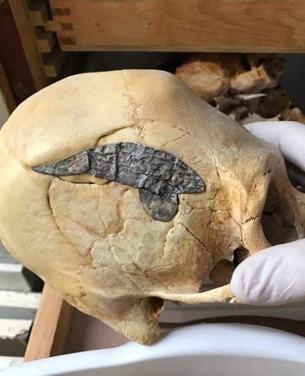 Перуанский удлинённый череп с хирургически имплантированным металлическим протезом