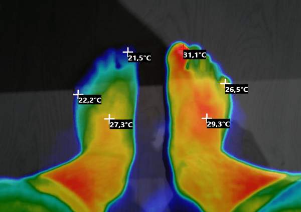 Тепловая камера показывает разницу температур обычной стопой и стопой с вросшим ногтем