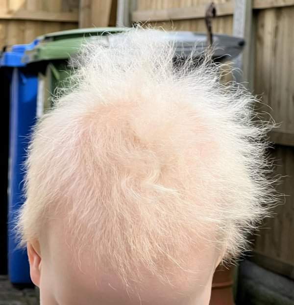 У моего сына синдром запутанных волос