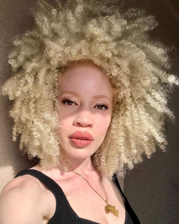 Диандра Форрест, девушка-альбинос африканского происхождения