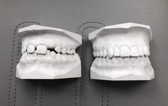 Восемь лет стоматологической работы по исправлению зубов, от начала до конца