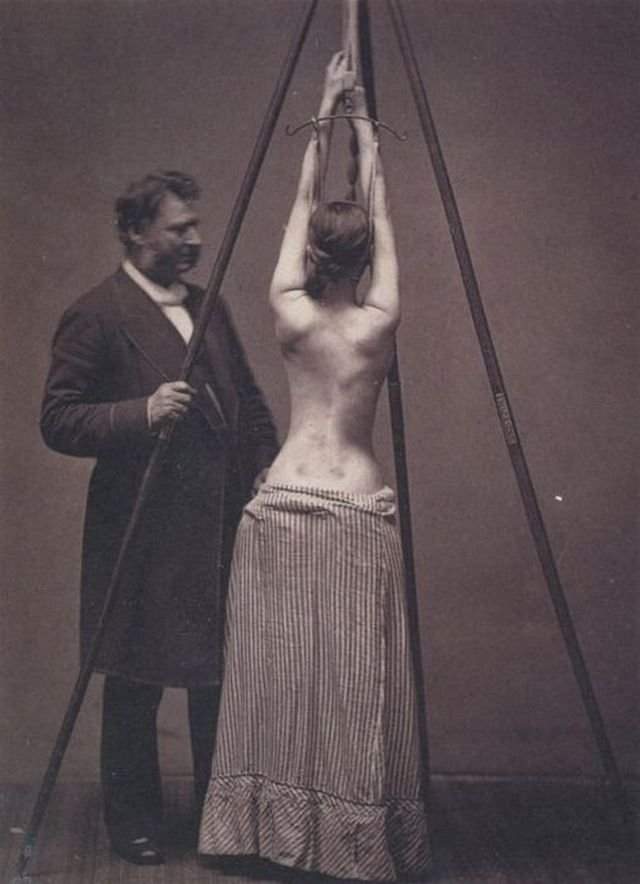 Лечение сколиоза, 1870–е, США.