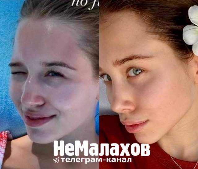 Невеста Лепса показала себя до пластики и после пластики Невеста Лепса показала себя до пластики и после пластики
