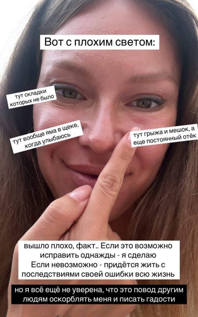 Рита Дакота и страшные последствия пластической операции Рита Дакота и страшные последствия пластической операции